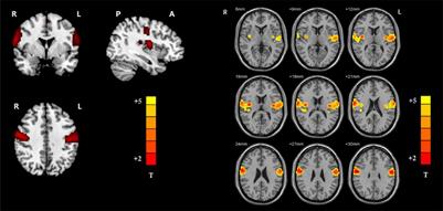 Abnormal Ventral Somatomotor Network Homogeneity in Patients With Temporal Lobe Epilepsy